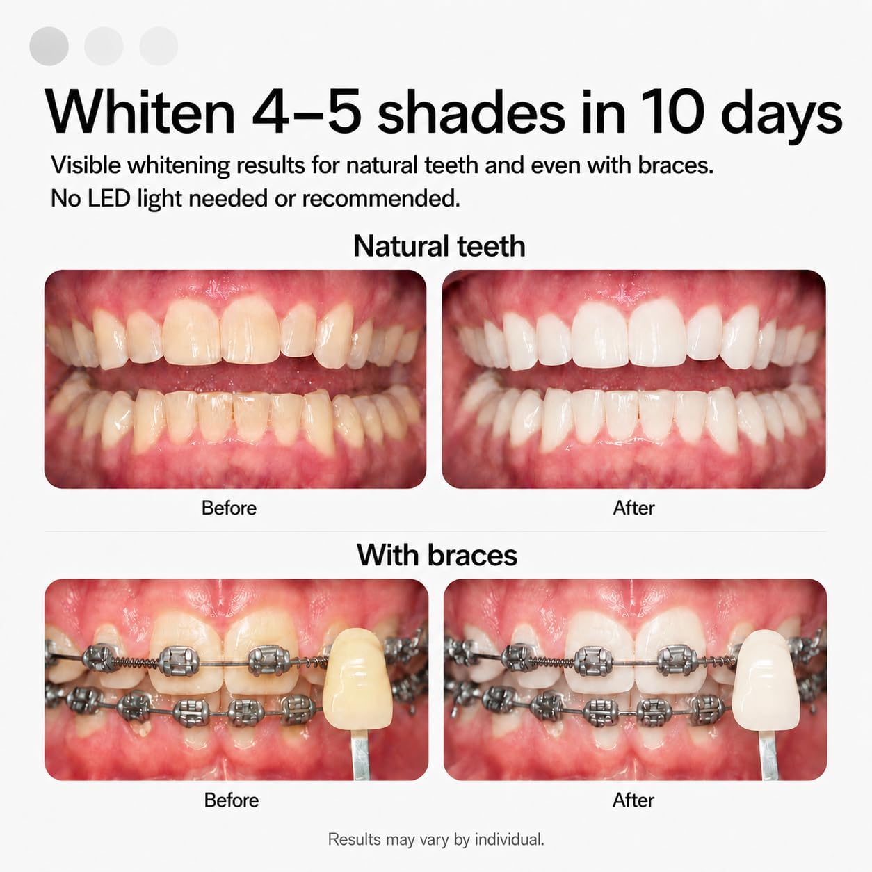 Highlights the prefilled tray format and the convenience of the whitening gel system.