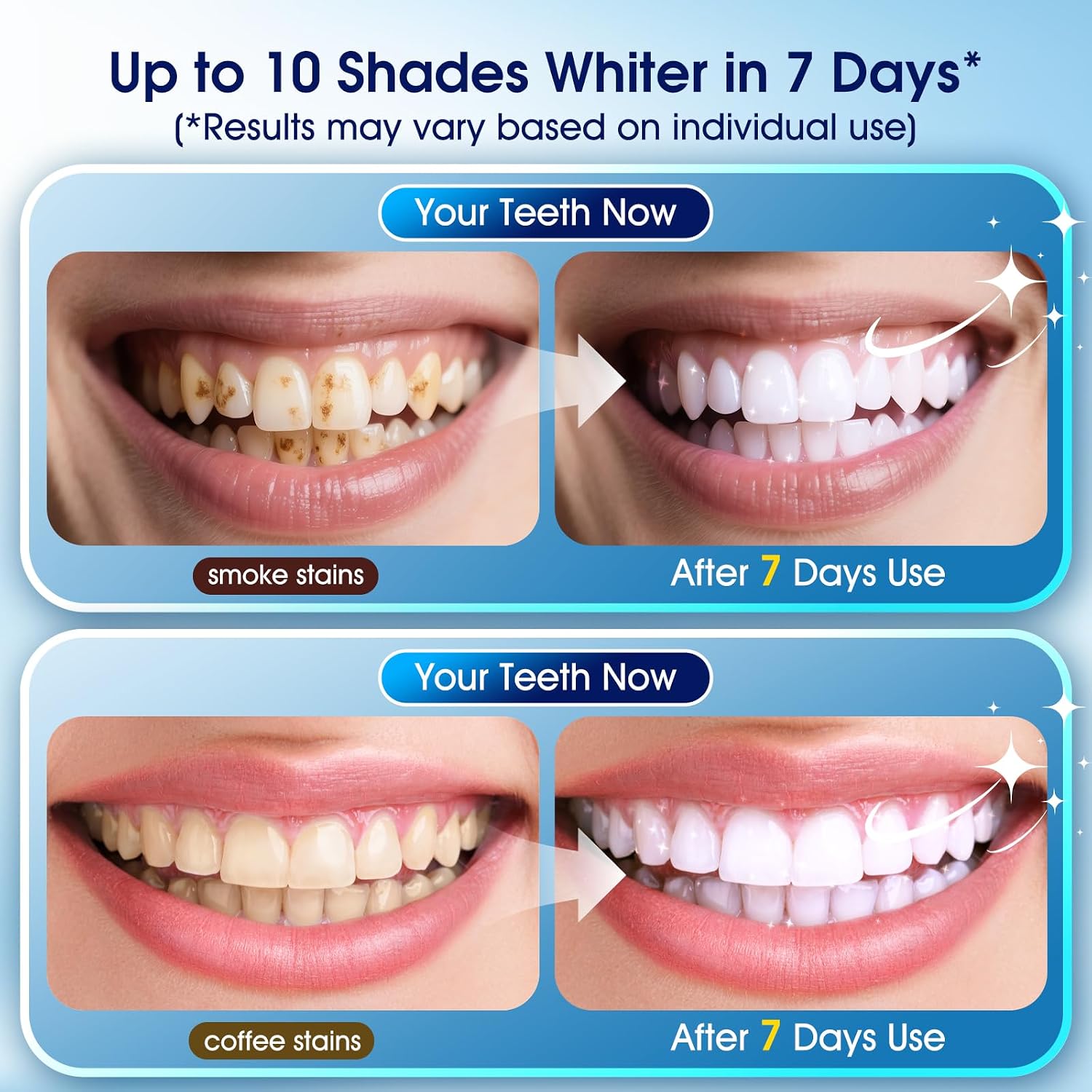 Teeth Whitening Kit With LED Light – 3 Whitening Gel Pens + 2 Desensitizing Pens – 35% Carbamide Peroxide – Whiten Teeth In 7 Days – Safe For Sensitive Teeth & Enamel, 0.7 Fl Oz (Grape)